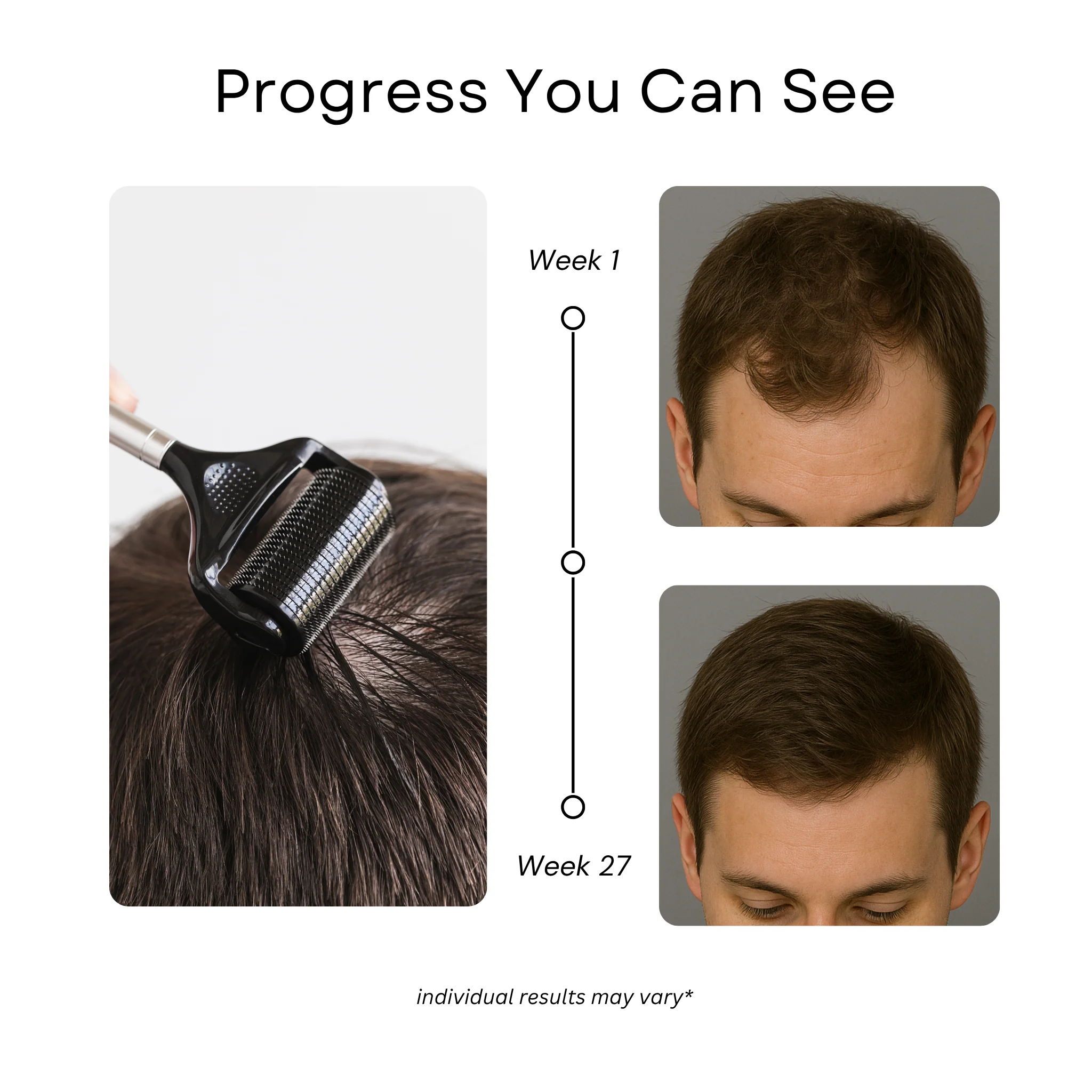 Scalp Roller 2.0 + Sanitizer - Image 4